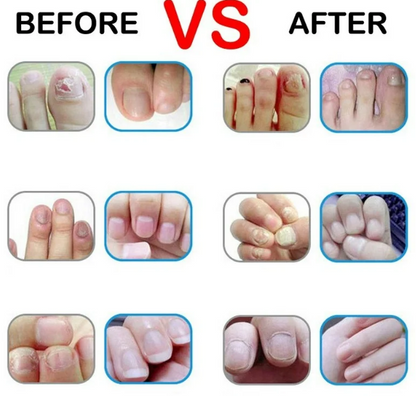 Crema Reparadora de Uñas Antihongos