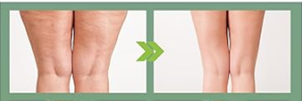 Parches Reductores de Celulitis KOAHDE – 30 unidades