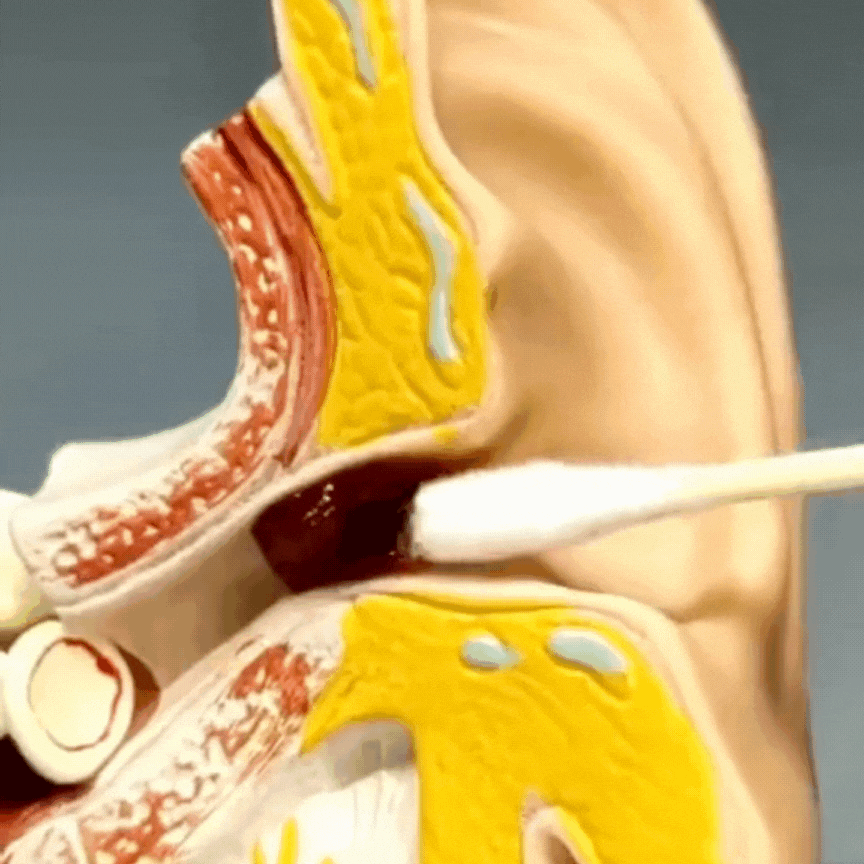 SMART SWAB – LIMPIADOR DE OÍDOS (Kit Completo 16ps)